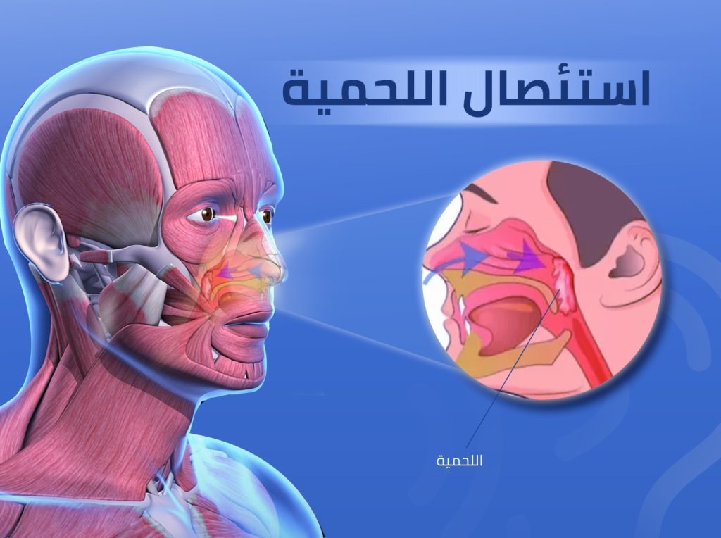 استئصال اللوزتين واللحمية