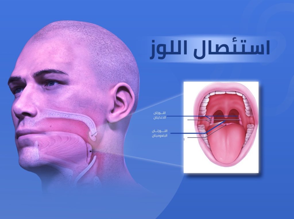 استئصال اللوزتين واللحمية