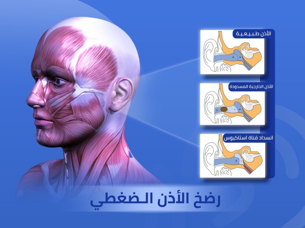 رضح الأذن الضغطي