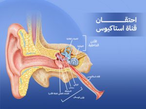 احتقان قناة استاكيوس