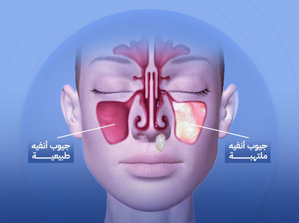 التهاب الجيوب الأنفية