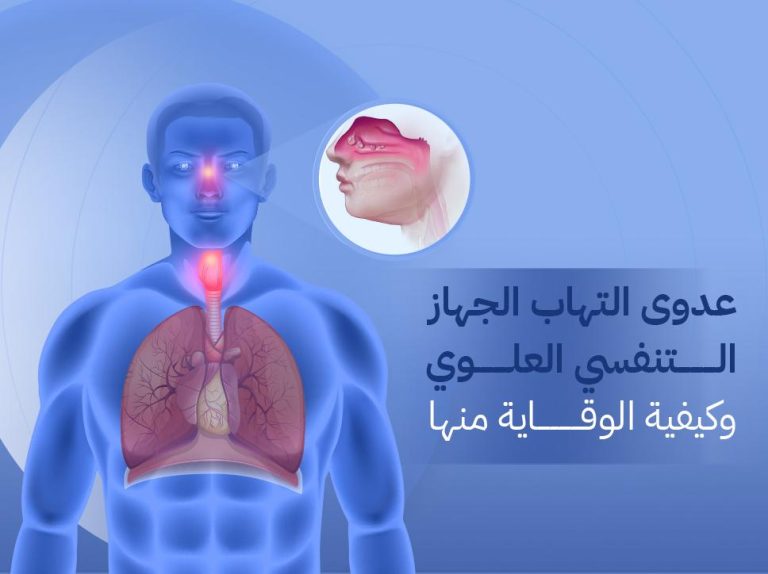 عدوى التهاب الجهاز التنفسي العلوي