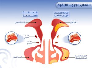 حساسية الأنف