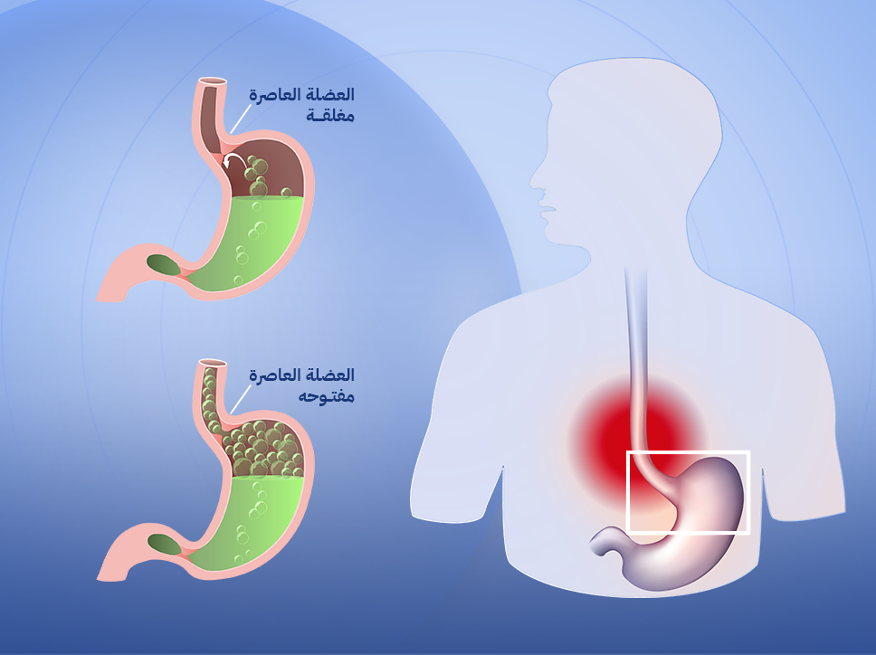 ارتجاع المريء