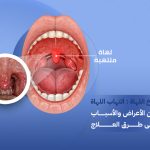 التهاب اللهاة