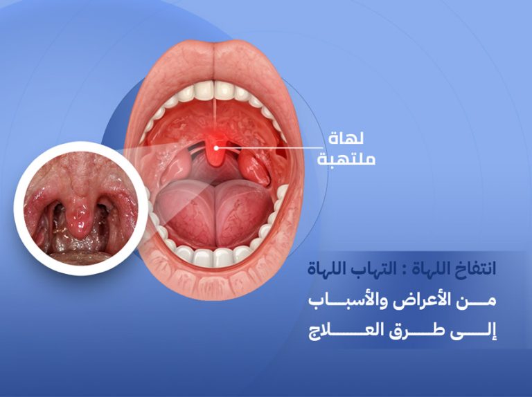 انتفاخ اللهاة: من الأعراض والأسباب إلى طرق العلاج