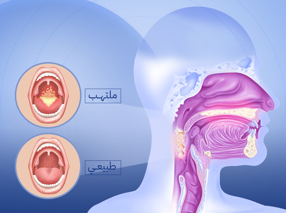 التهاب البلعوم