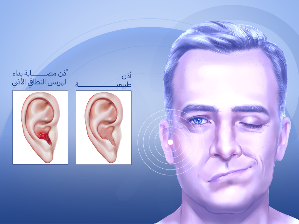 الهربس النطاقي الأذني