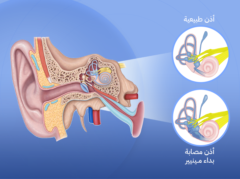 مرض مينير