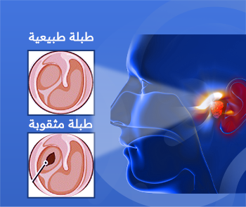 ترقيع طبلة الأذن