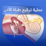 ترقيع طبلة الأذن