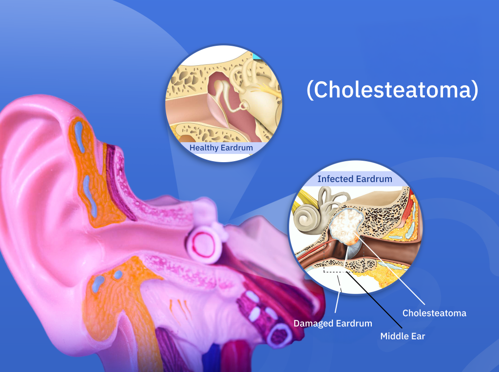 Cholesteatoma