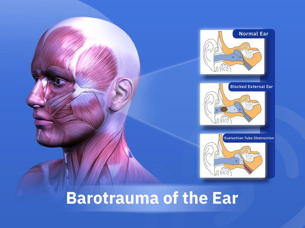 Ear Barotrauma