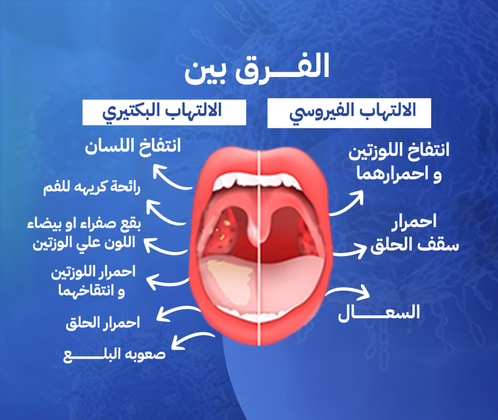 الفرق بين الالتهاب الفيروسي والبكتيري