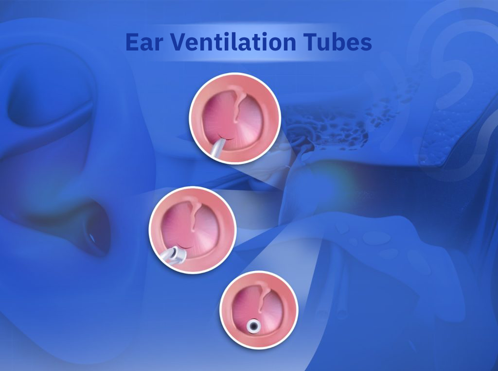 Ear Ventilation Tubes