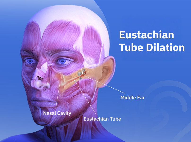Eustachian tube dilatation