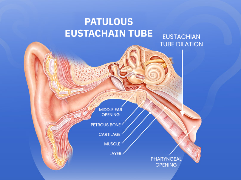 Dr Saleh Sakr El3amary Eustachian Tube Dilatation