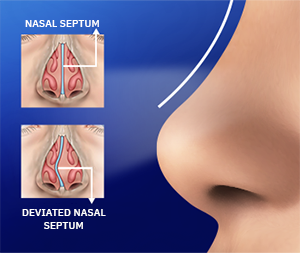 Nasal Septum Deviation