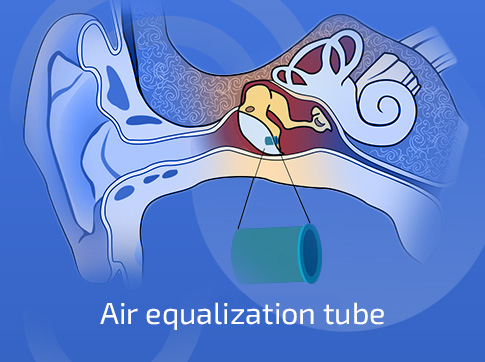 Ear Tubes