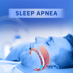 Sleep Apnea