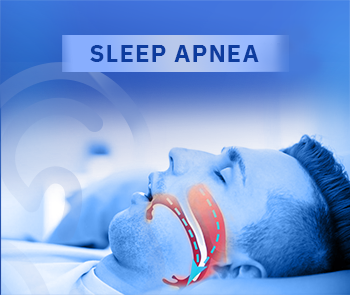 Sleep Apnea