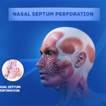 Nasal Septal Perforation