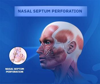 Nasal Septal Perforation
