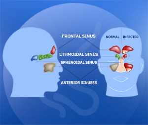 Bad Nasal Odor