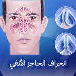 انحراف الحاجز الأنفي