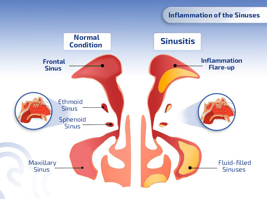Allergic Rhinitis