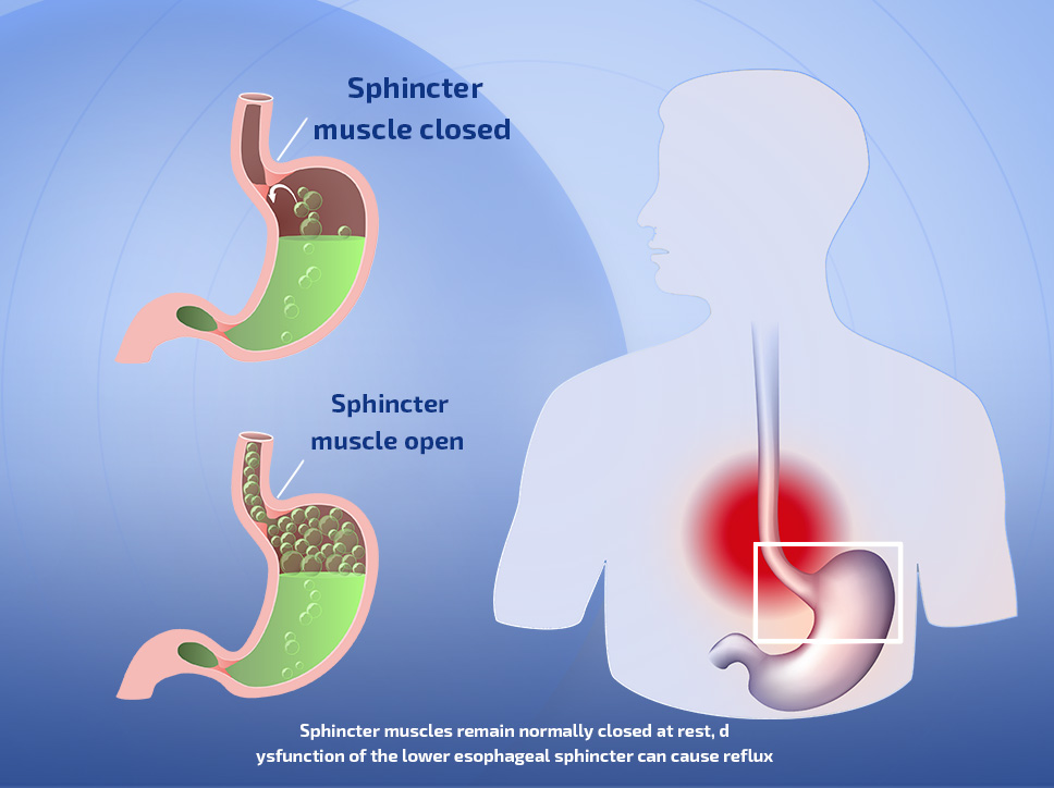 Allergic Rhinitis