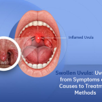 Uvulitis