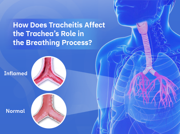 Tracheitis