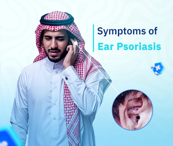 Psoriasis of the ear