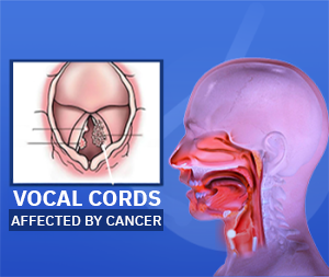 Laryngeal Cancer