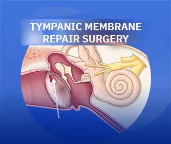 Tympanoplasty