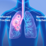 Tracheitis