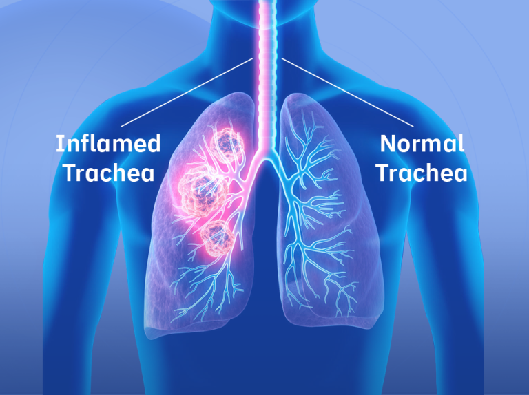 Tracheitis